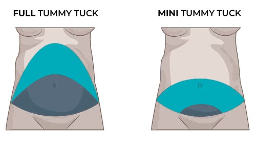 Mini Tummy Tuck vs Full Tummy Tuck