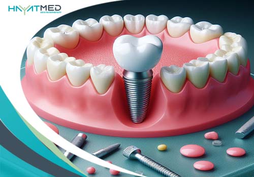 Benefits Of Full-Mouth Dental Implants