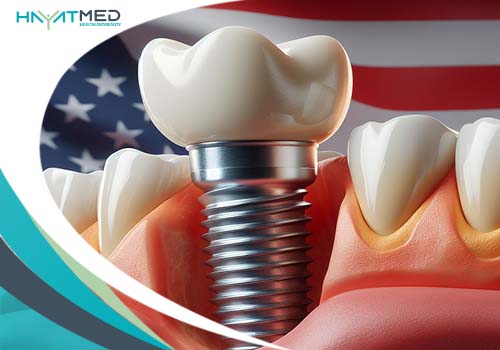 How much does it cost for Full-mouth implants in the USA