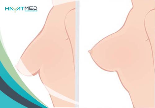 What is a breast lift with implants new 2024