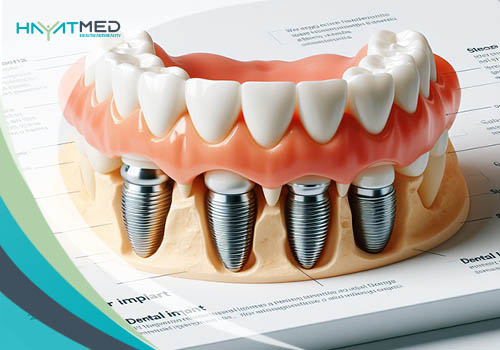 Benefits of dental procedures Dental Implants Istanbul