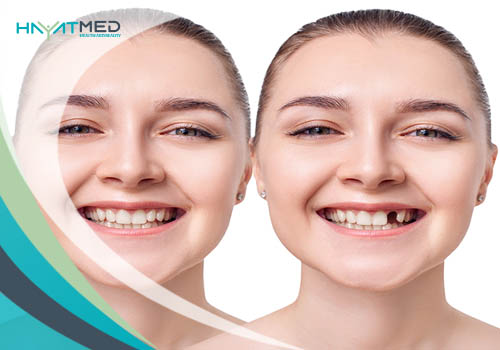 Dental Bridges pros Tooth Implant or Bridge Which Is Better