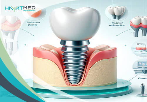 Dental Implants Components & Benefits c c