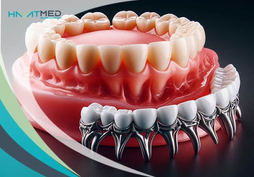 Dental implant vs. bridge vs. denture d