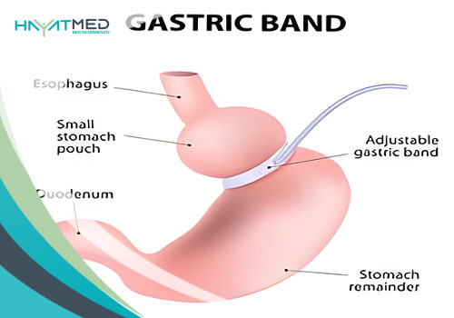 Gastric band vs. sleeve new f