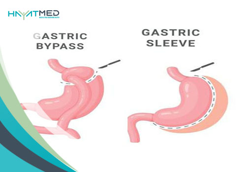 How-They-Modify-Stomach-Size Gastric Sleeve Vs Gastric Bypass
