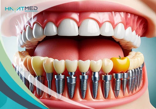 How much does a full-mouth dental implant cost ;ll