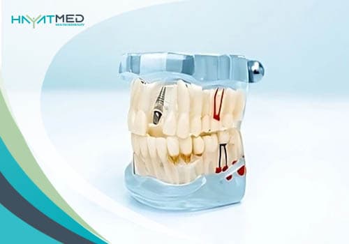 What-Are-Dental-Implants-in-istanbul new Dental Implants in Istanbul