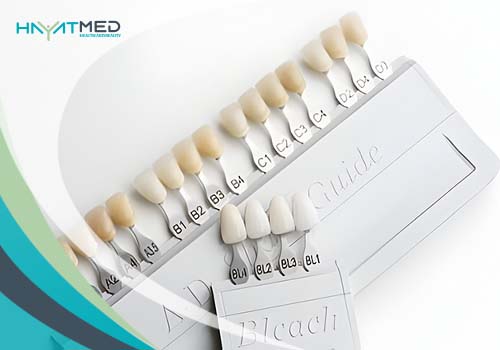 What are the different types of veneers nn 2024