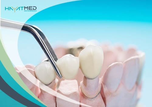 What-is-a-Dental-Bridge Dental Implant Vs Dental Bridge