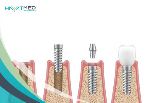 What-is-a-Dental-Implant Dental Bridge Vs Implants