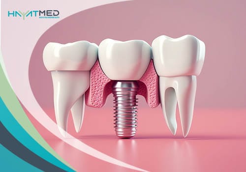 What is a dental implant Dental Implants Cost