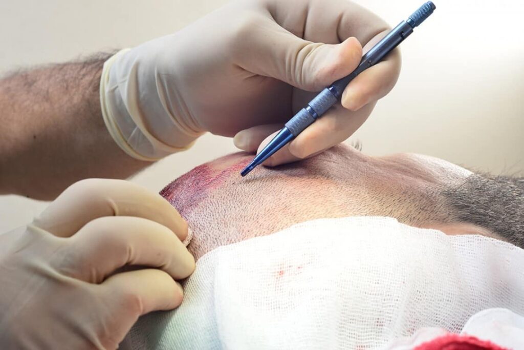 What is FUE Hair Transplant?