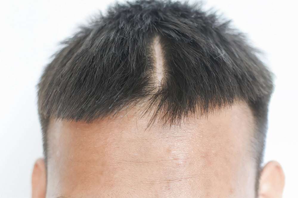 How to Get a Hair Transplant on a Scar