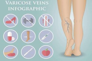 Varicose veins in pregnancy can occur anytime during pregnancy, though in most cases they become visible as the baby grows bigger.