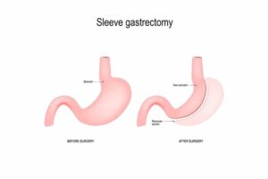 Gastric Sleeve Weight Loss