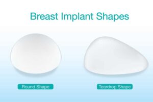 Breast Implant with Lift