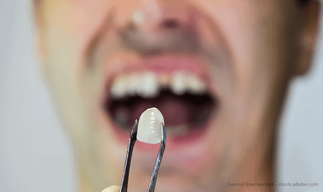 When should you consider teeth crown