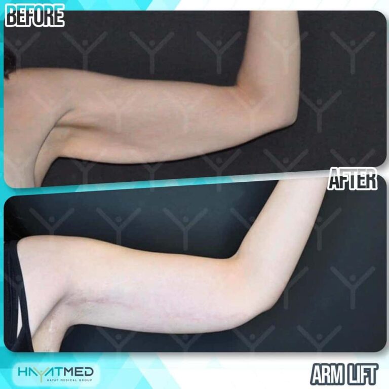 arm lift before and after 2