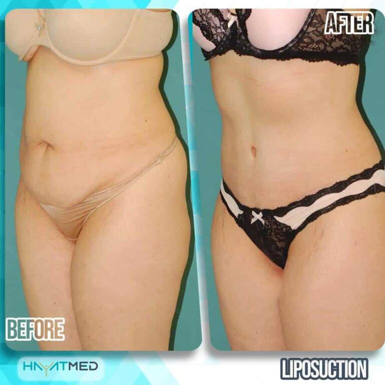 liposuction before and after 1