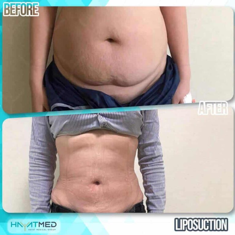 liposuction before and after 11
