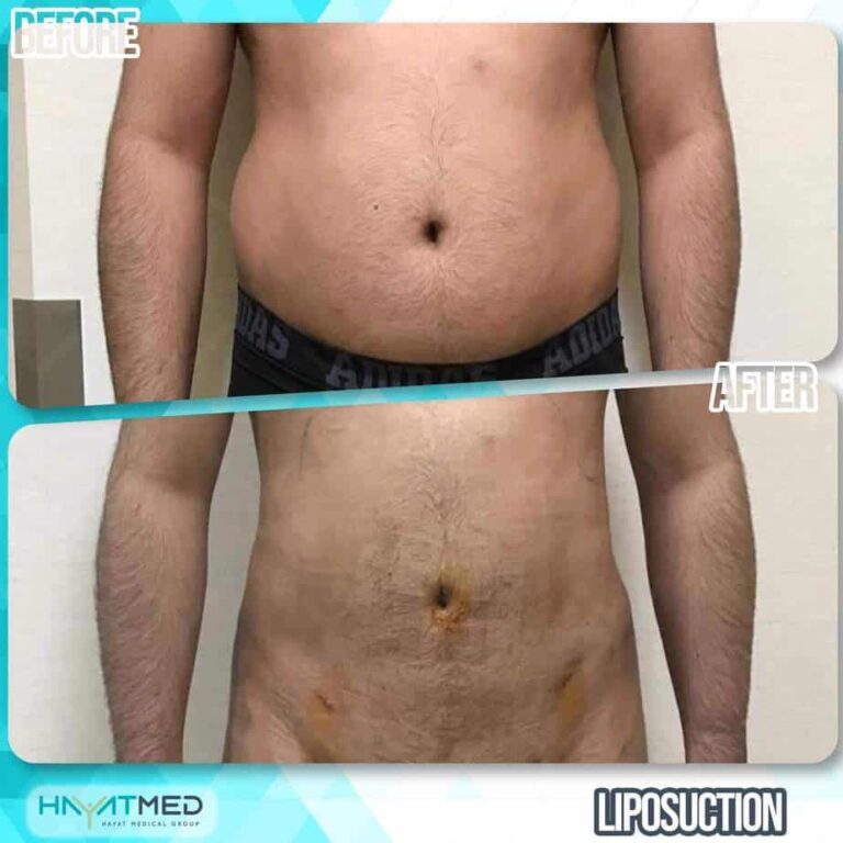 liposuction before and after 12