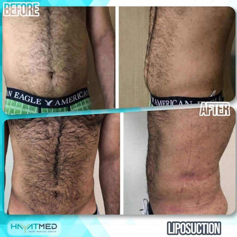 liposuction before and after 13