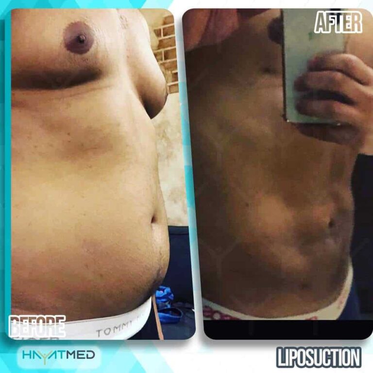 liposuction before and after 14