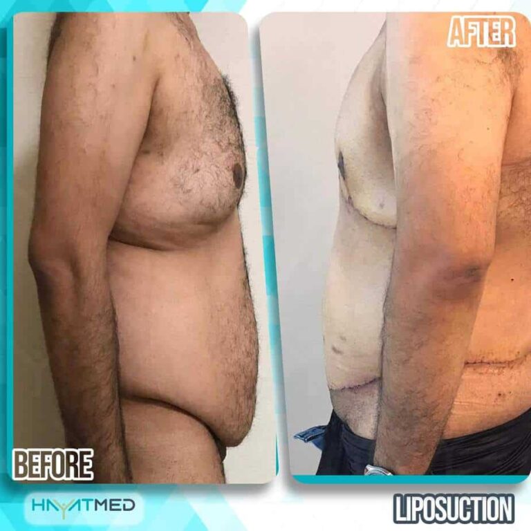 liposuction before and after 15