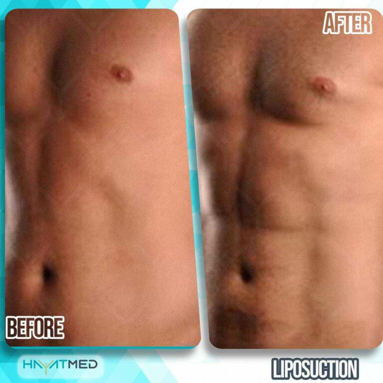 liposuction before and after 18