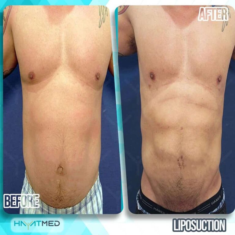 liposuction before and after 2