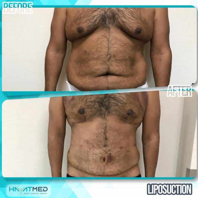 liposuction before and after 5