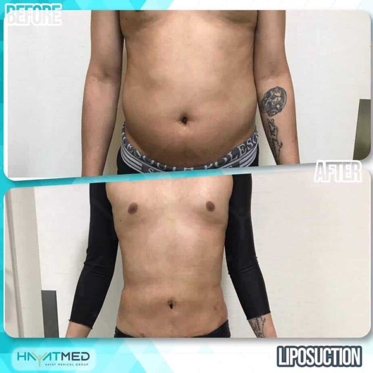 liposuction before and after 6