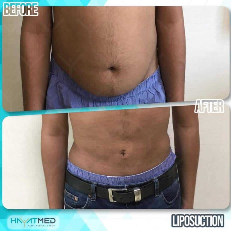 liposuction before and after 7