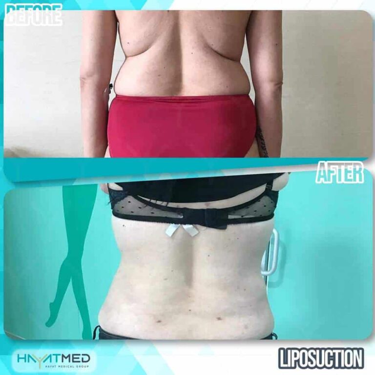 liposuction before and after 8