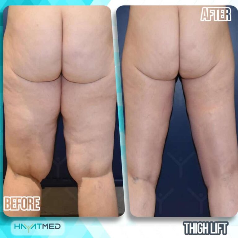 thigh lift Before and after 1