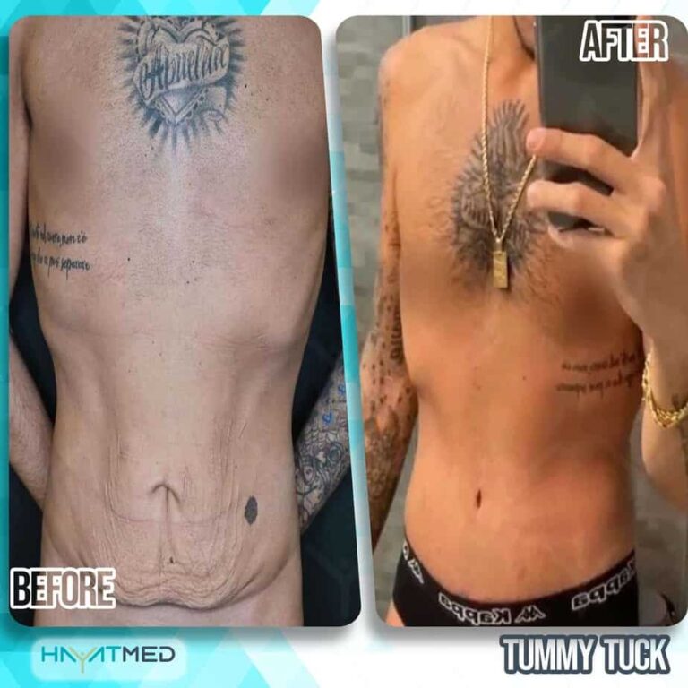 tummy tuck Before and After 2