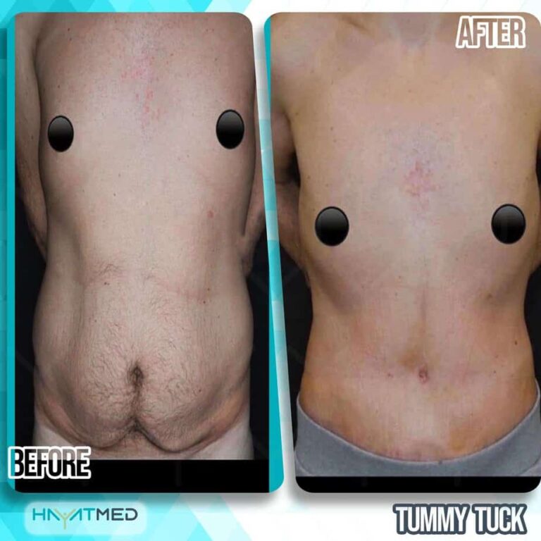 tummy tuck Before and After 3