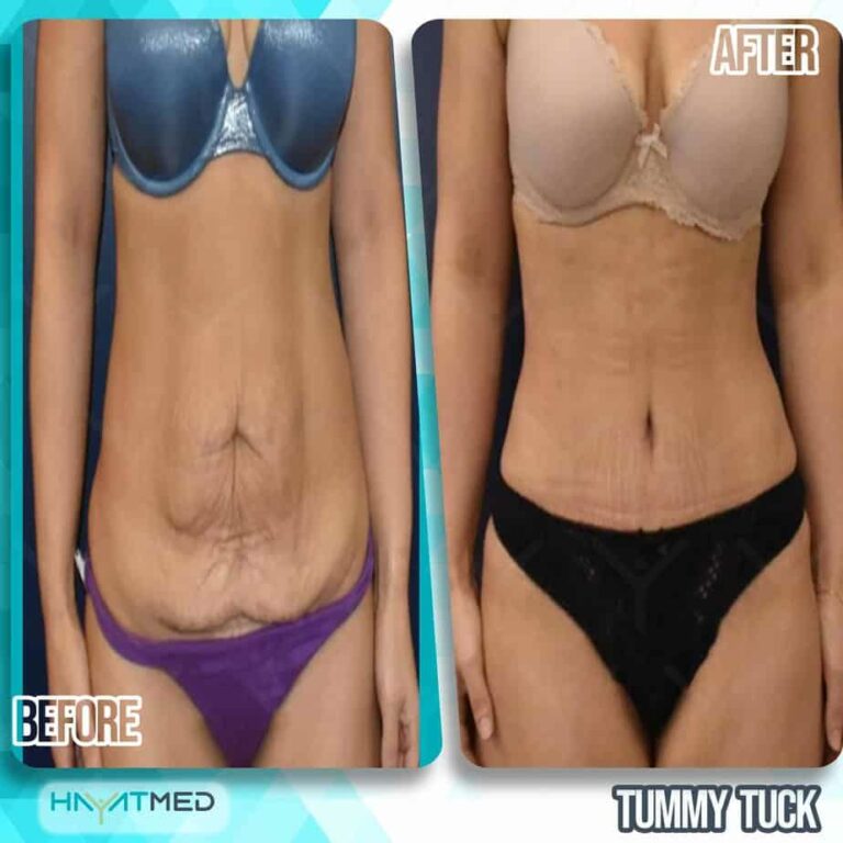 tummy tuck Before and After 4