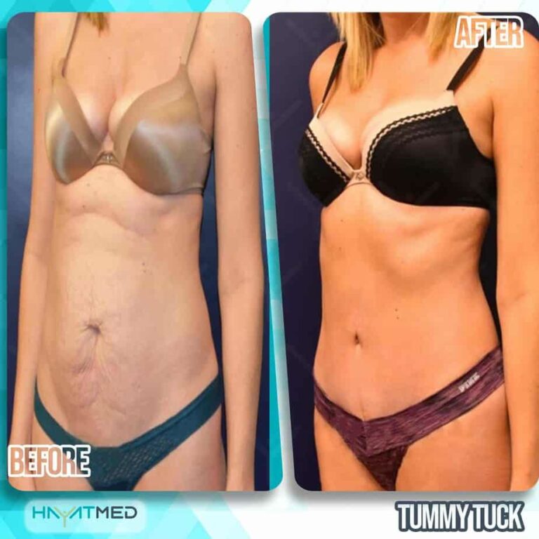 tummy tuck Before and After 5