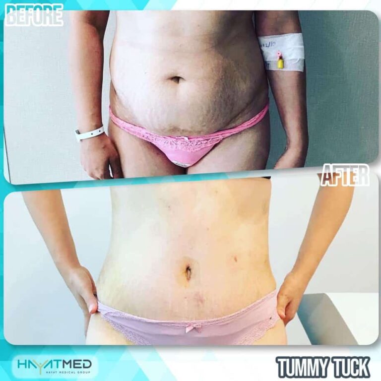 tummy tuck Before and After 6