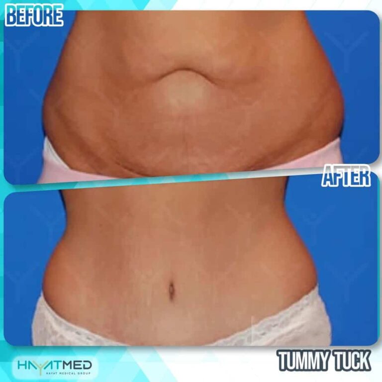 tummy tuck Before and After 9