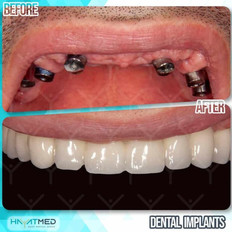 Dental implants before and after 2
