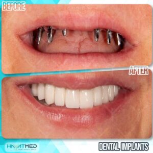 Dental implants before and after 4