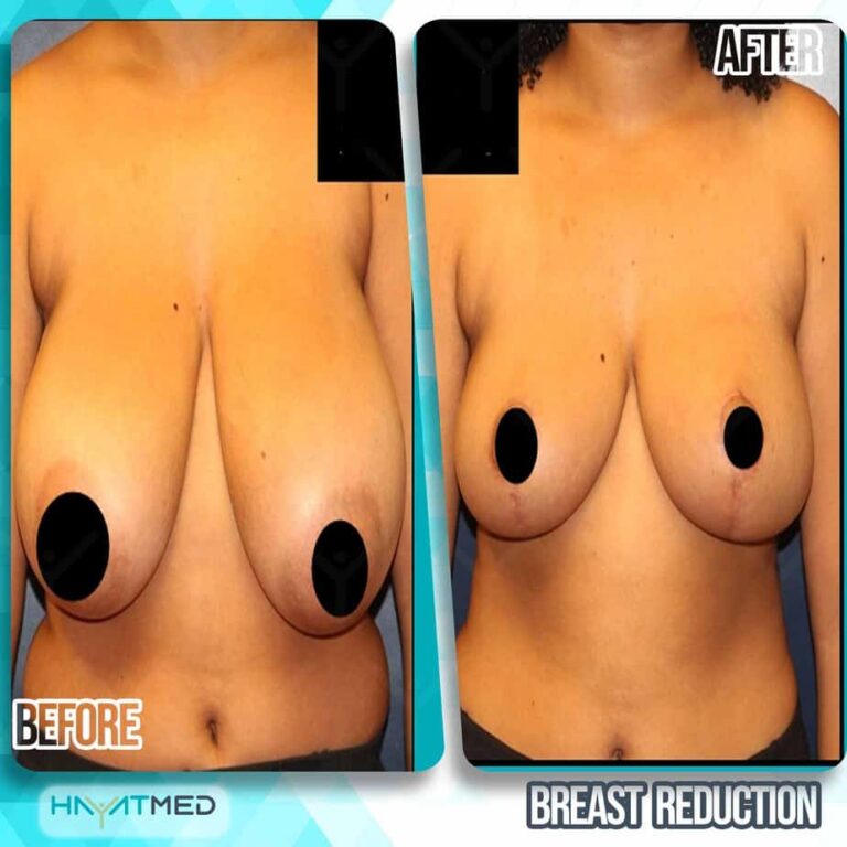 breast reduction before and after 1