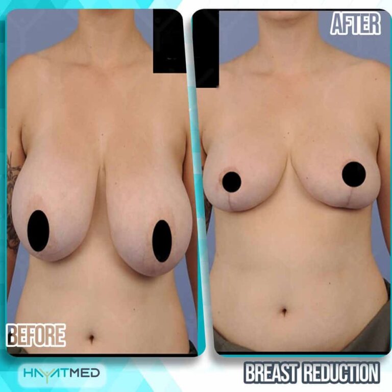 breast reduction before and after 2