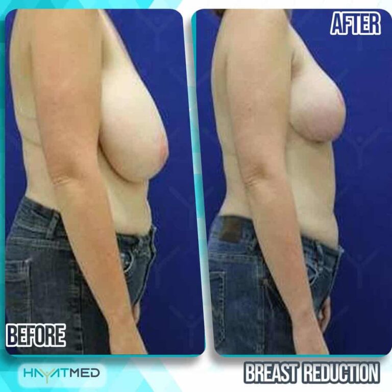 breast reduction before and after 3