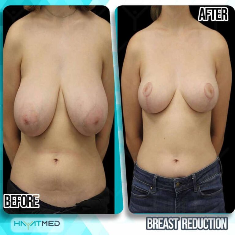 breast reduction before and after 4