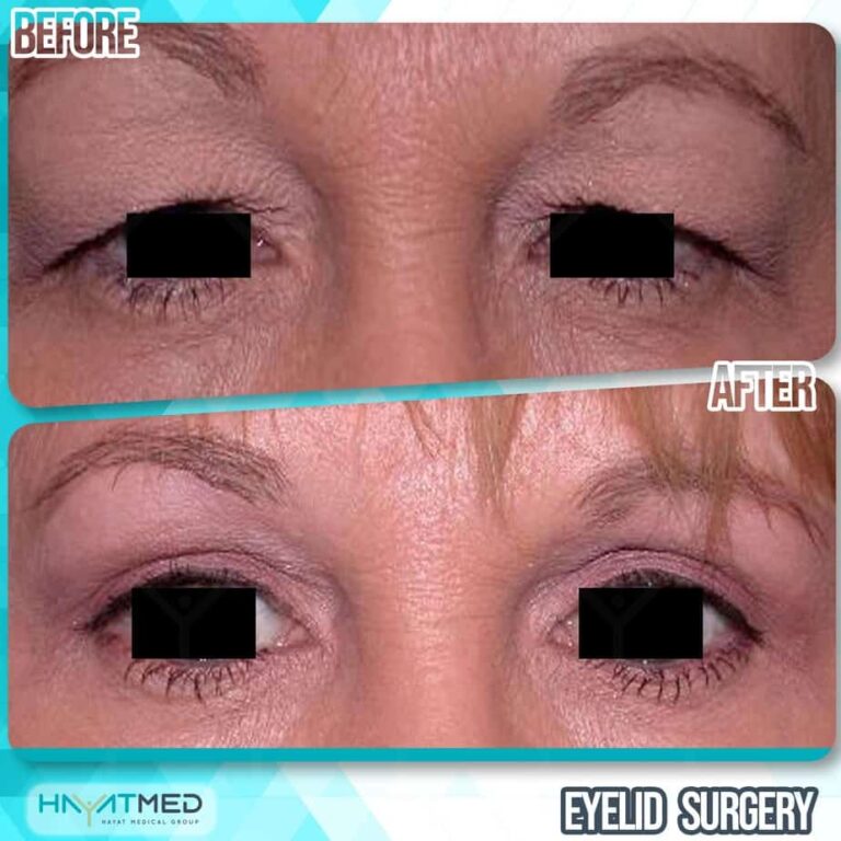 eyelid surgery before and after 2