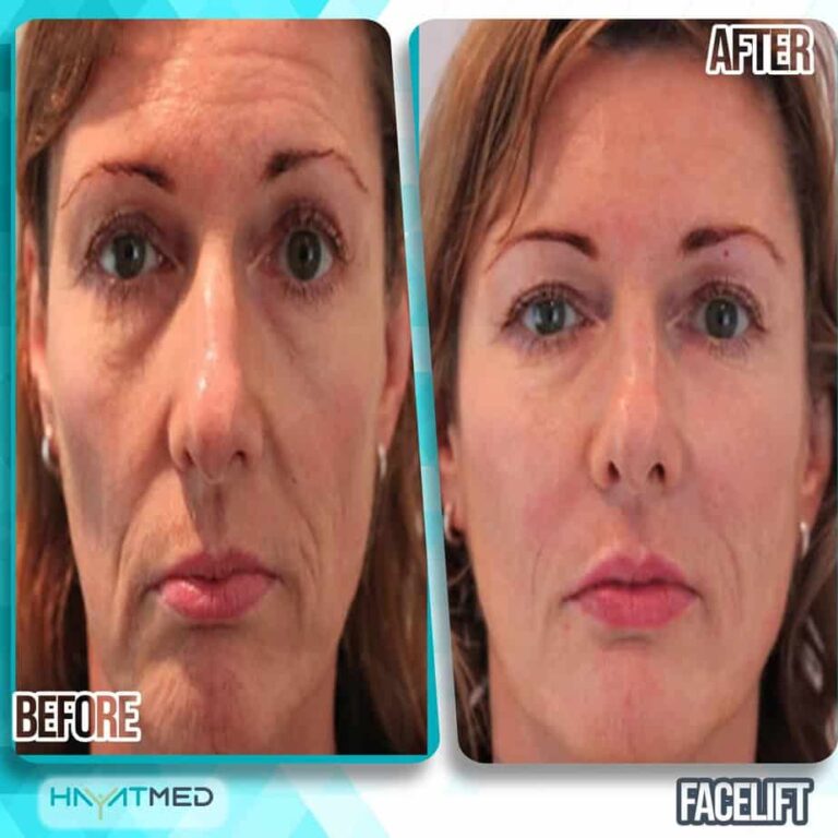face lift before and after 5